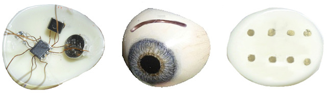 Пересадка бионического глаза при инвалидности по зрению (диабет)