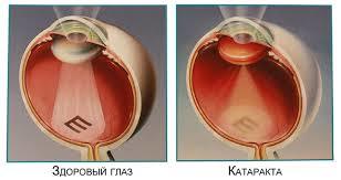 Экстракапсулярная экстракция катаракты (ЭЭК) - операция по замене хрусталика при катаракте