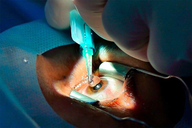 При замене хрусталика при катаракте неправильно подобрали линзу (ИОЛ)