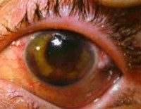Контузия (ушиб) глаза: симптомы и лечение, степени и негативные последствия
