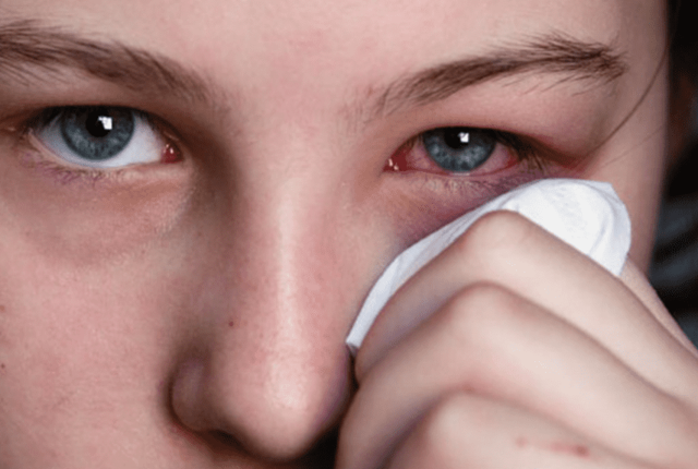 Кератит роговицы глаза: причины, симптомы и эффективные методы лечения заболевания
