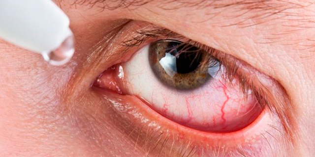 Эписклерит глаз: причины, симптомы и эффективные методы лечения заболевания