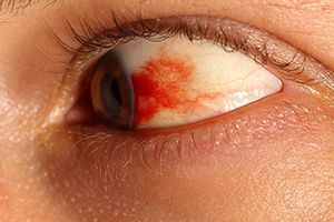 Гемофтальм (кровоизлияние в глаз) после вакцинации от коронавируса