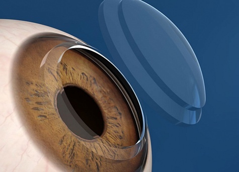 Операции при помутнении роговицы глаза - стоит ли делать и где?