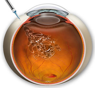 БОСЛАБ Зрение - аппарат для лечения глаз - описание, показания к применению и отзывы