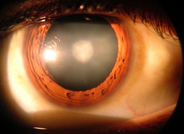 EDOF ИОЛ - имплантация в один глаз при катаракте