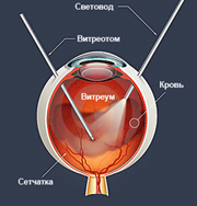 Витреоретинальный пучок (ПХРД сетчатки) - нужна ли лазерная коагуляция