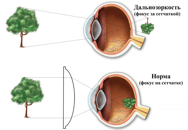 Аппаратное лечение дальнозоркости у детей - (детской гиперметропии зрения)