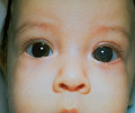 Врожденная глаукома: причины, признаки и лечение