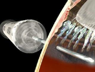 Озурдекс (дексаметазон) при тромбозе центральной вены сетчатки - цена укола