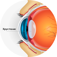 При замене хрусталика при катаракте неправильно подобрали линзу (ИОЛ)