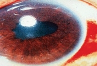 Увеит глаза (передний и задний, острый и хронический): причины, симптомы и эффективные методы лечения заболевания