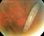 Офтальмомиазы - паразиты в глазах человека: причины, симптомы и лечение