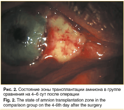 Птеригиум глаза и его эффективное лечение (капли и операция по удалению)