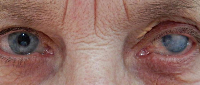 Операции при сосудистом бельме роговицы глаза