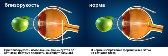 Близорукость (миопия) второй степени (средняя) - диагностика и лечение