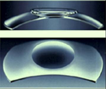 Имплантируемые факичные заднекамерные ИОЛ как альтернатива лазерной операции