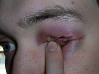 Роговично-склеральное проникающее ранение глаза