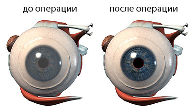 Операции при помутнении роговицы глаза - стоит ли делать и где?