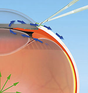 Хирургическое лечение глаукомы (операция глаукомы) - все методы лечения