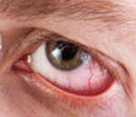 Лагофтальм (заячий глаз) - причины возникновения симптома и его лечение