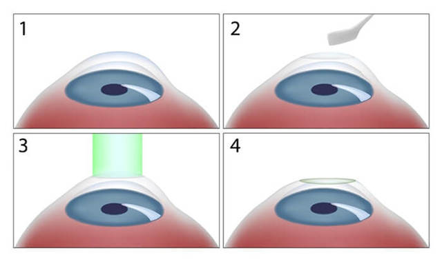 ФРК (фоторефракционная кератэктомия) - лазерная коррекция зрения. Цены и отзывы, видео операции!
