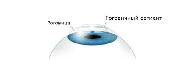 Улучшить зрение при тонкой роговице - лазерная коррекция или ИОЛ