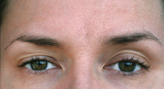 Птоз - опущение верхнего века глаза: причины, степени и лечение
