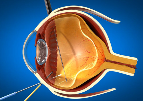 Восстановление зрения при гемианопсии и отслойке сетчатки глаза