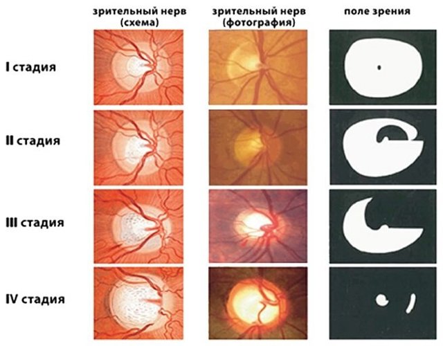 Лечение полной атрофии зрительного нерва на одном глазу