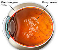 Деструкция стекловидного тела (ДСТ) и синдром сухого глаза (ССГ)