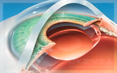 Низкое зрение после имплантации мультифокальных линз