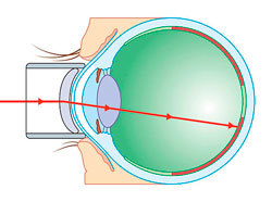 Ограничительная лазеркоагуляция сетчатки глаза - показания, отзывы и цены!