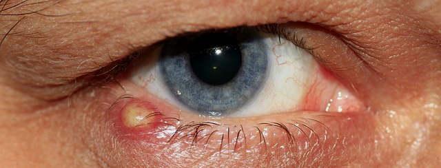 Лекарства для лечения ячменя - глазные капли и мази