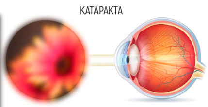 Замена хрусталика глаза - можно ли делать без вакцинации от коронавируса