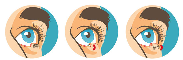 Выворот нижнего века глаза (эктропион) и его эффективное лечение (операция блефаропластики)