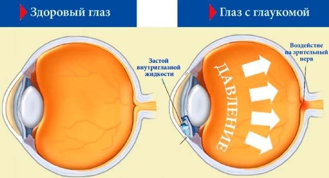Противопоказания и осложнения при глаукоме
