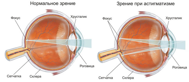 Лечение астигматизма - очки и контактные линзы, лазерная коррекция, хирургическая кератопластика