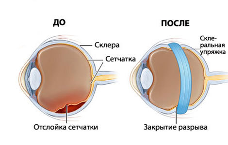 Лечение отслоения сетчатки с помощью бионического глаза