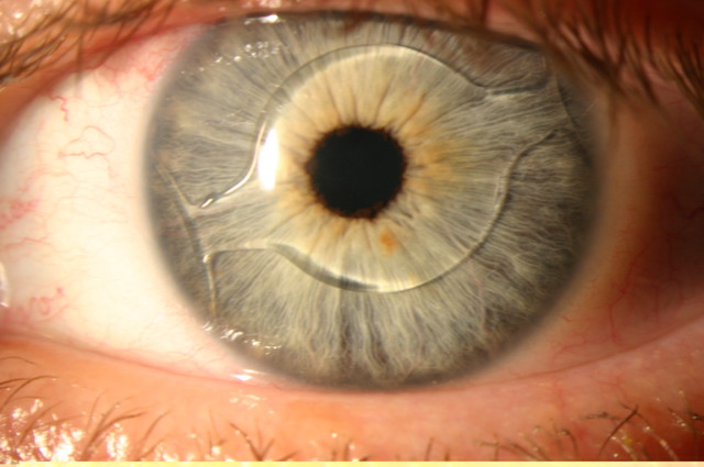 Операция по замене хрусталика глаза после вакцинации от коронавируса