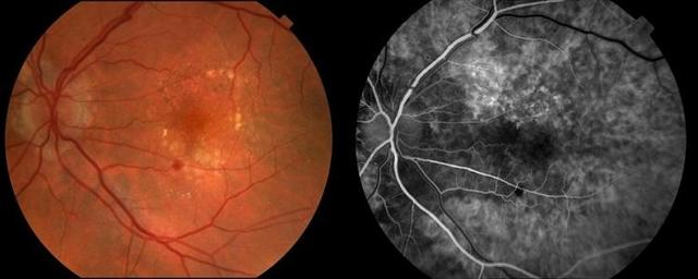 ФАГ - флуоресцентная ангиография сетчатки глаза - исследование в офтальмологическом центре