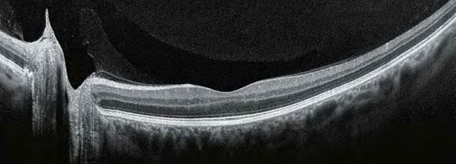 Оптическая когерентная томография (ОКТ) глаза - что означает
