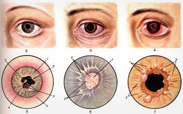 Иридоциклит глаза (острый и хронический): причины, симптомы и эффективные методы лечения заболевания