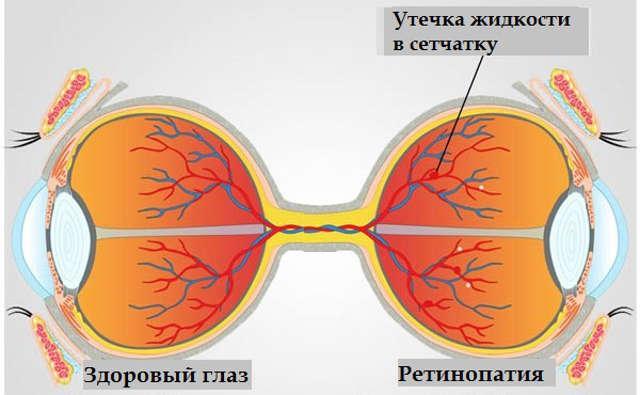 Диабетическая ретинопатия сетчатки глаз - классификация (стадии) ретинопатии, симптомы и методы лечения