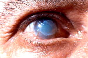 Ожоги глаз и их лечение. Первая помощь при ожогах солнцем, сваркой, химическими веществами