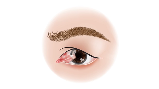 Птеригиум глаза и его эффективное лечение (капли и операция по удалению)