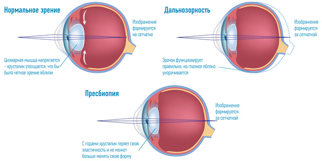 Очки при дальнозоркости (пресбиопии) - коррекция зрения очками.