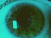 Восстановление зрения при близорукости высокой степени - факичные иол или лазер
