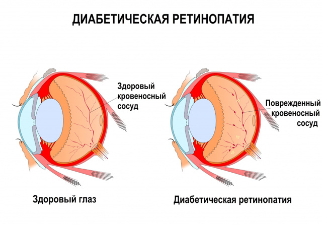 Повреждение сетчатки глаза новорожденному фонариком от телефона
