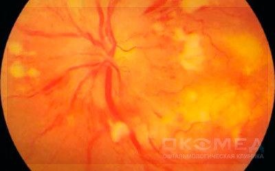 Гипертонический ангиослероз сетчатки глаза - развитие, симптомы, профилактика, лечение